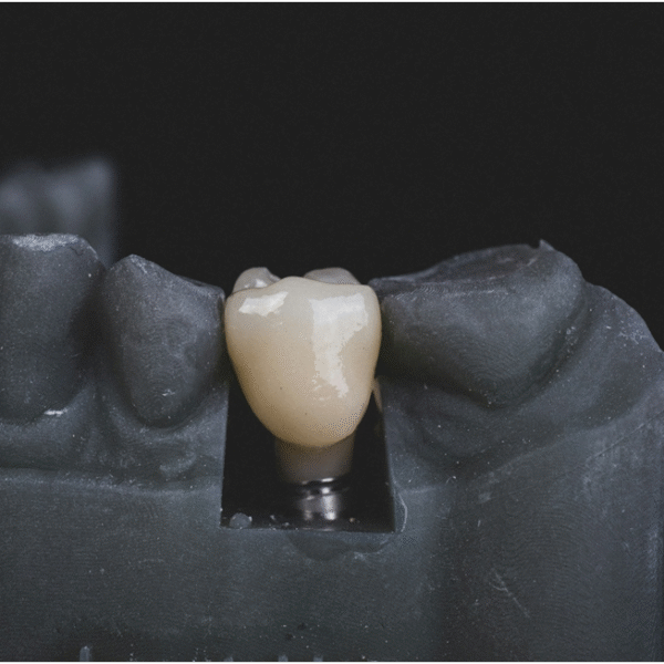 How Does Bone Health Affect the Success of Dental Implants?